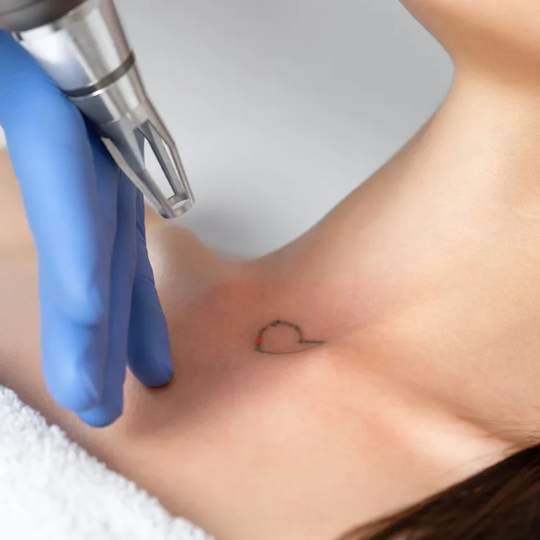 laser-tattoo-removal-banner